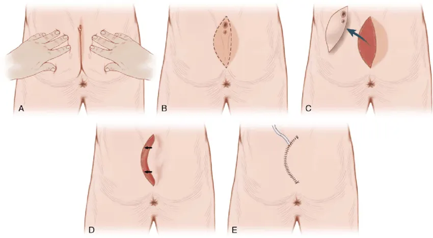 Cleft lift procedure steps illustration showing A) initial examination, B) incision marking, C) tissue removal and flap creation, D) cleft shallowing, and E) final closure with sutures