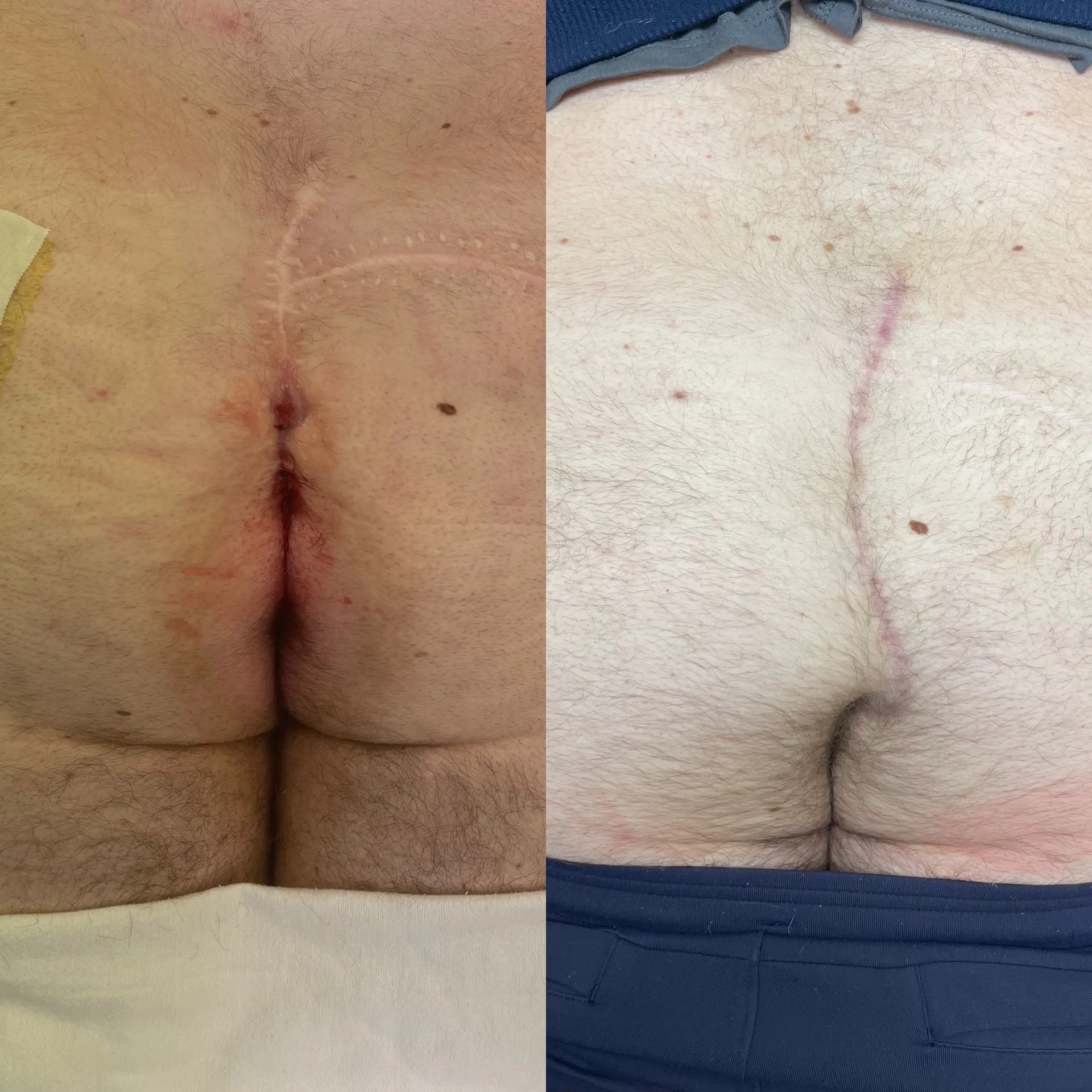 Cleft lift surgery before and after, patient 1, full healing at 3 to 10 weeks post-op