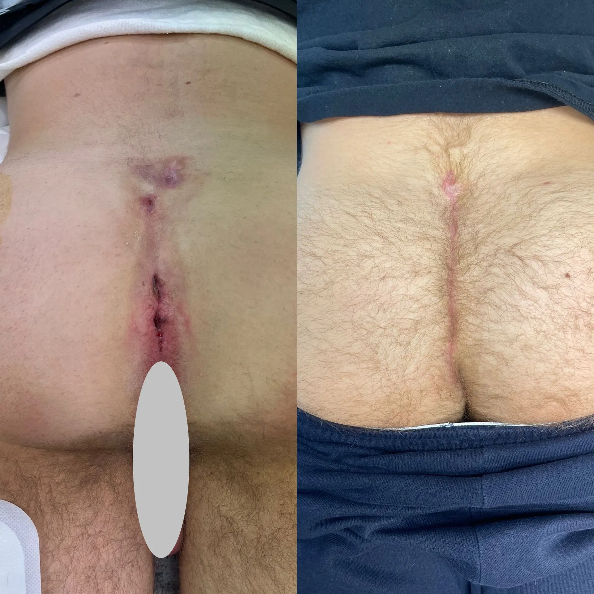 Cleft lift surgery before and after, patient 3, full healing at 3 to 10 weeks post-op