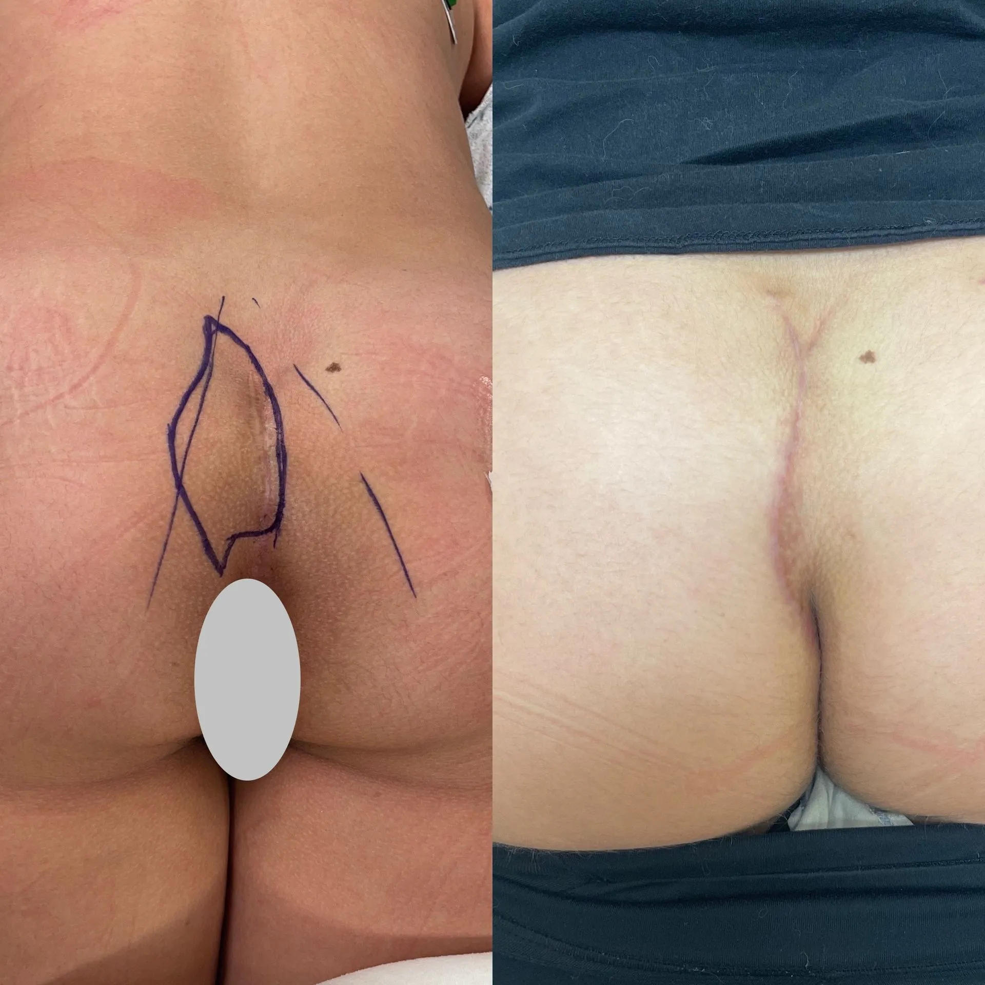 Cleft lift surgery before and after, patient 5, full healing at 3 to 10 weeks post-op