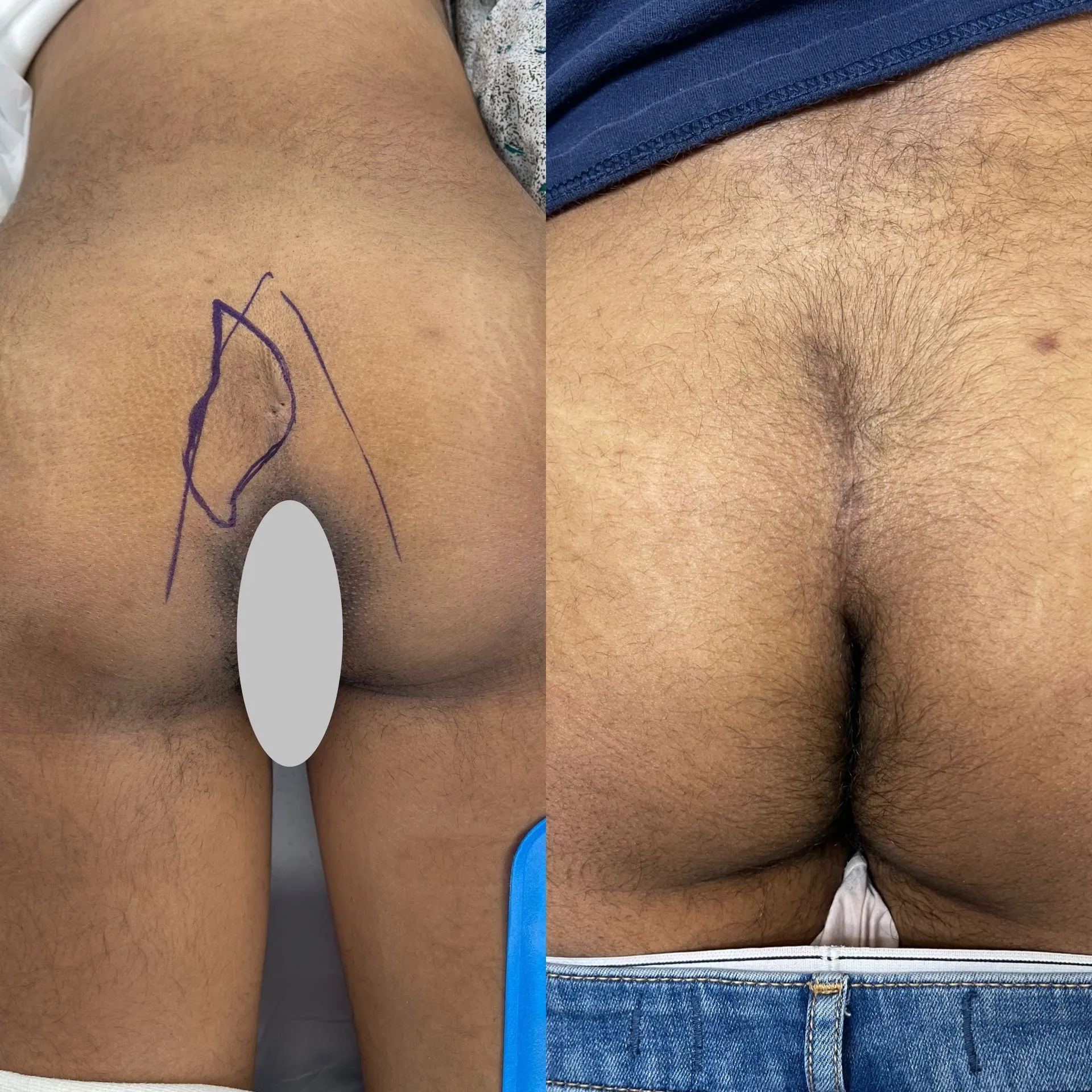 Cleft lift surgery before and after, patient 8, full healing at 3 to 10 weeks post-op