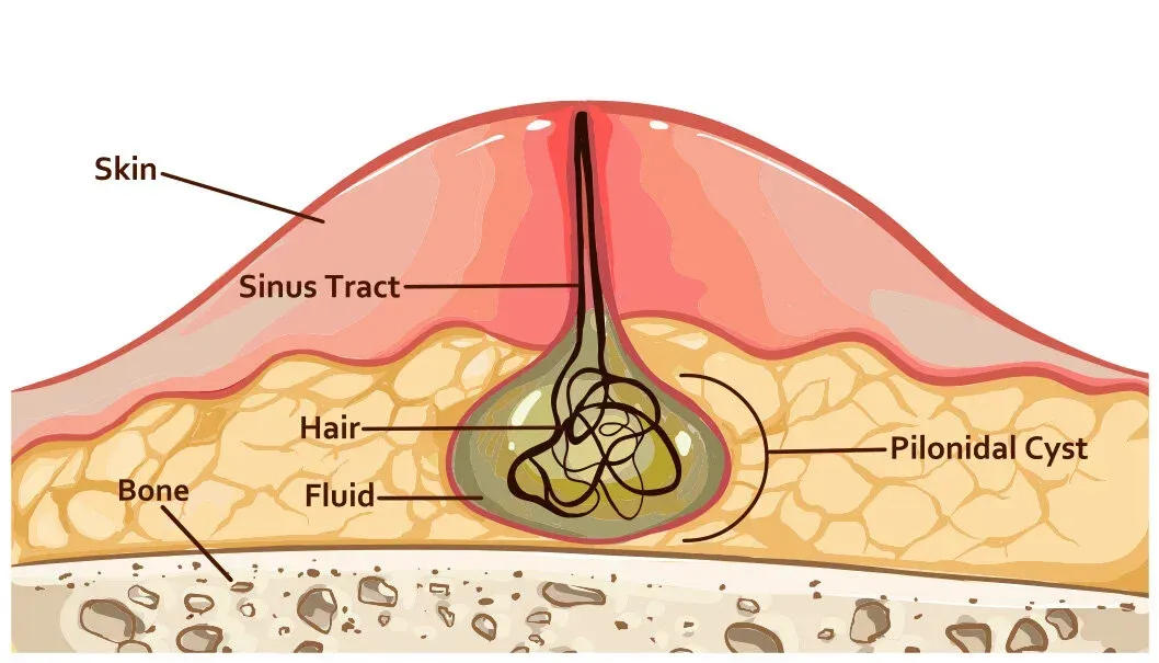 Anatomical diagram showing pilonidal cyst structure with sinus tract, hair, fluid, and bone layers