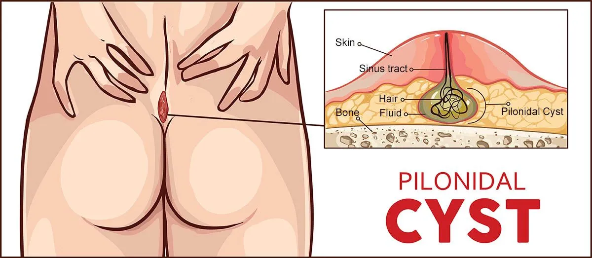 What is Pilonidal Disease?